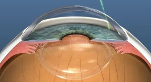 Laser en Glaucoma e Hipertensión Ocular