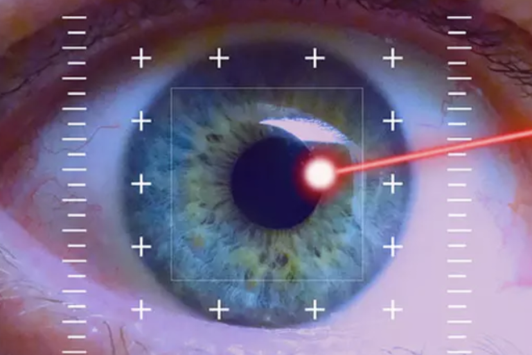 La nueva era del láser en Glaucoma