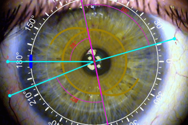 Aberrometría De Alto Orden Ophthalmunity 9765