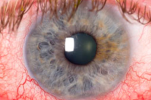 Glaucoma y Uveítis